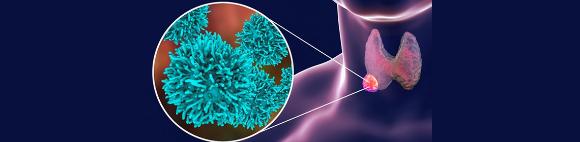 THYROID CANCER AND RADIOACTIVE IODINE AND LEUKEMIA